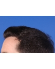 After Hair Transplant &nbsp;Hairlines